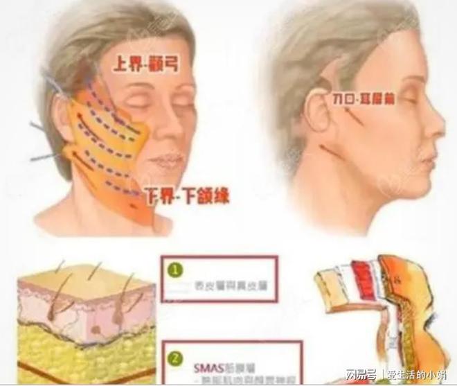 CQ9电子筋膜悬吊面部提升术多少钱？筋膜悬吊面部提升术多久有效果？(图7)