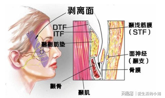 CQ9电子筋膜悬吊面部提升术多少钱？筋膜悬吊面部提升术多久有效果？(图12)